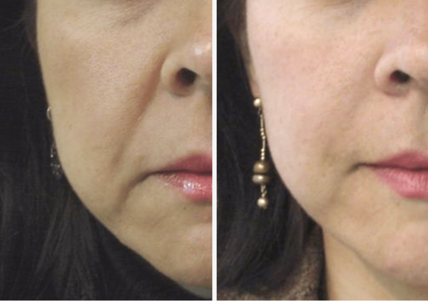 Laser Hautabtragung2 Vorher Nachher Dermatologie Hanau